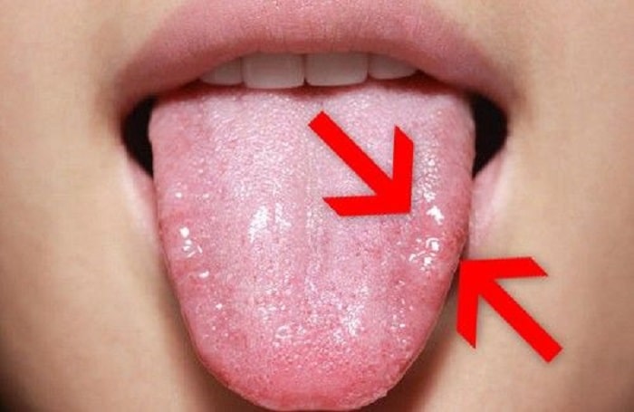 llagas en la lengua