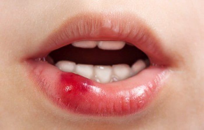 heridas en la boca