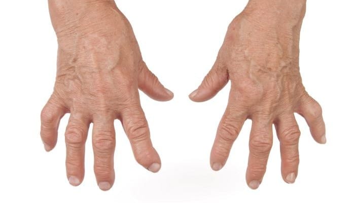medicina natural para artritis muy efectiva