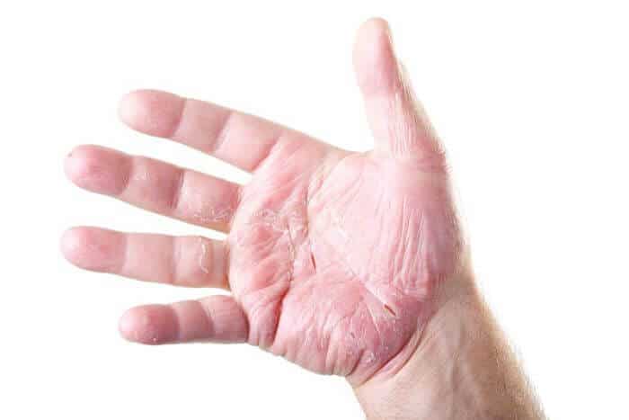 Psoriasis en las manos - síntomas