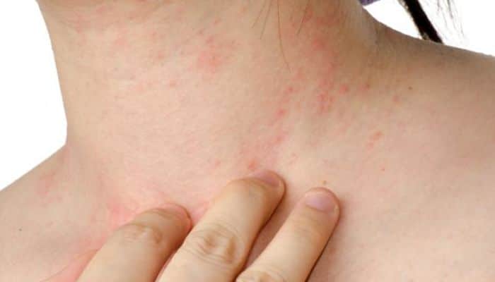 Remedios Caseros para alergias en la piel Efectivos