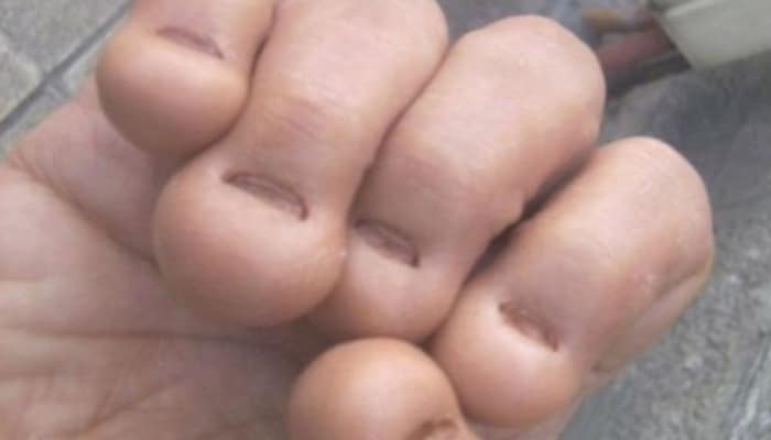 Deformaciones por morderse las uñas