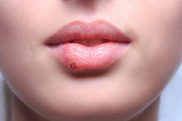 remedios caseros para el herpes labial