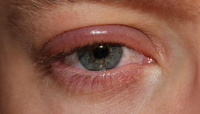 Infección en los ojos y sus síntomas