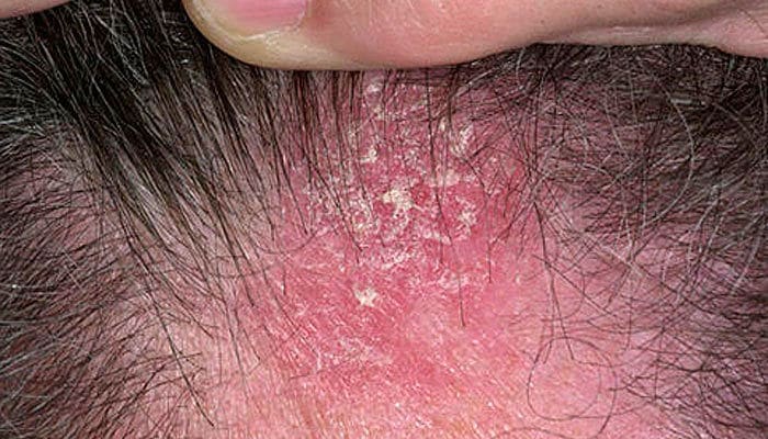La dermatitis de contacto causa picazón en el cuero cabelludo 