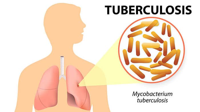 La tuberculosis causa sudores nocturnos en mujeres