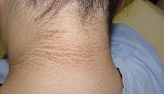 Remedios caseros para aclarar la pigmentación oscura en el cuello