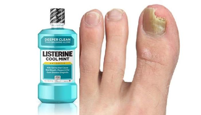 Remojar Listerine y Vinagre para hongos en las uñas