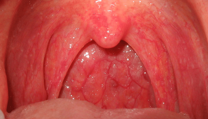 Tratamiento de cáncer de garganta 