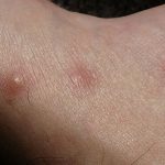 combate la picadura de pulgas