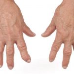 medicina natural para artritis