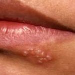 remedios caseros para el herpes labial Consejos