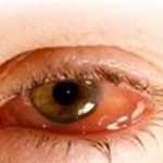 Infección en los ojos