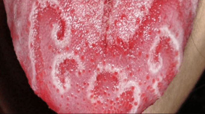 Puntos rojos en la punta de la lengua o manchas