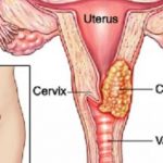 Cáncer Cervical: Causas, Síntomas Y Tratamientos