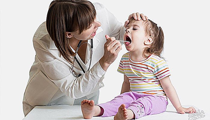 Quitar las adenoides o amígdalas también puede ser una solución para los niños que tienen repetidas infección del oído medio