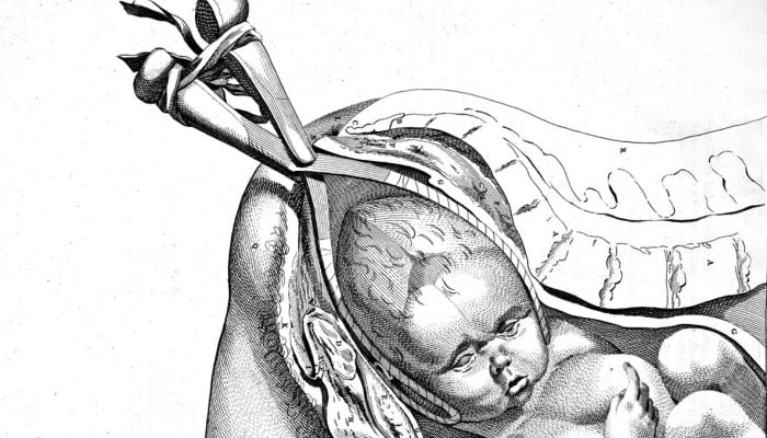 placenta previa al sacar al bebé