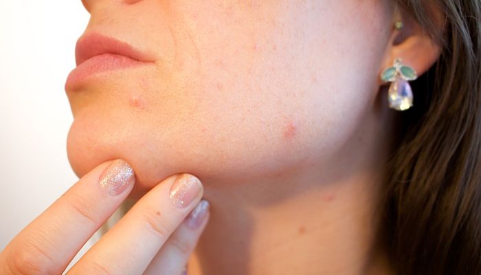 Las espinillas y el acné son problemas comunes de la piel de los adolescentes