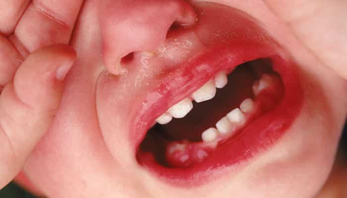 Los problemas de salud bucal, como encías hinchadas o sangrantes o úlceras bucales recurrentes, a menudo están relacionados con niveles de deficiencia de vitamina C
