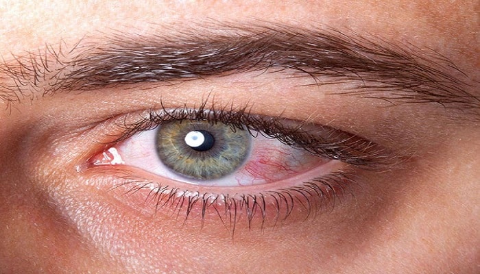 Sindrome de los ojos secos