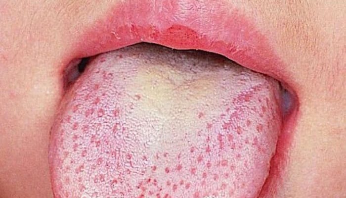 tratamientos de la lengua blanca