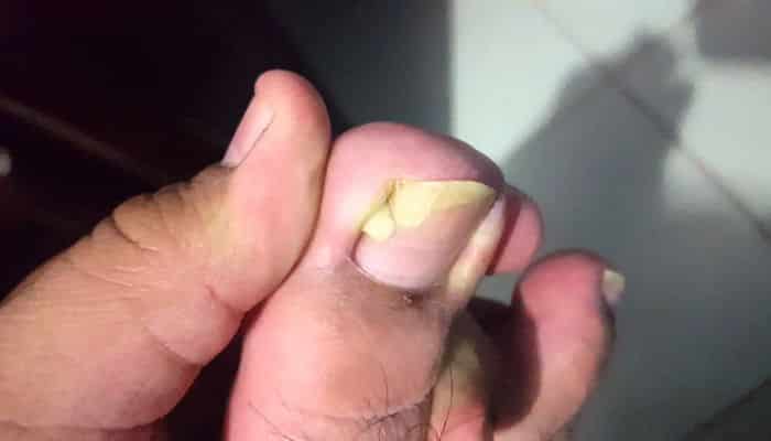 un dedo infectado