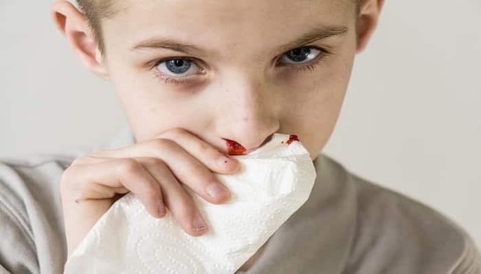 pasos para detener las hemorragias nasales