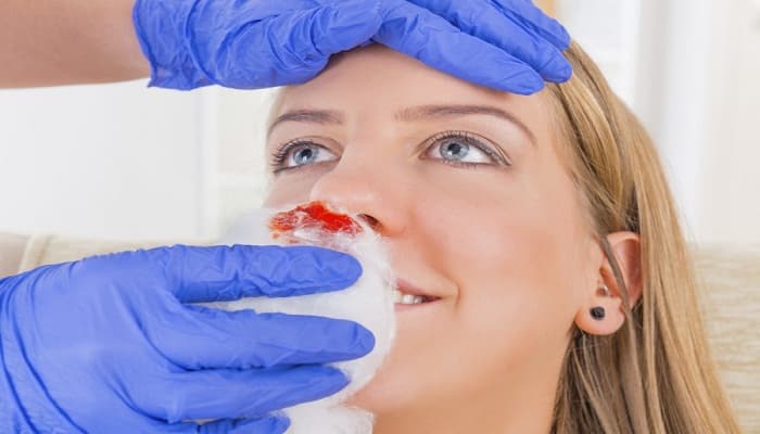 detener las hemorragias nasales